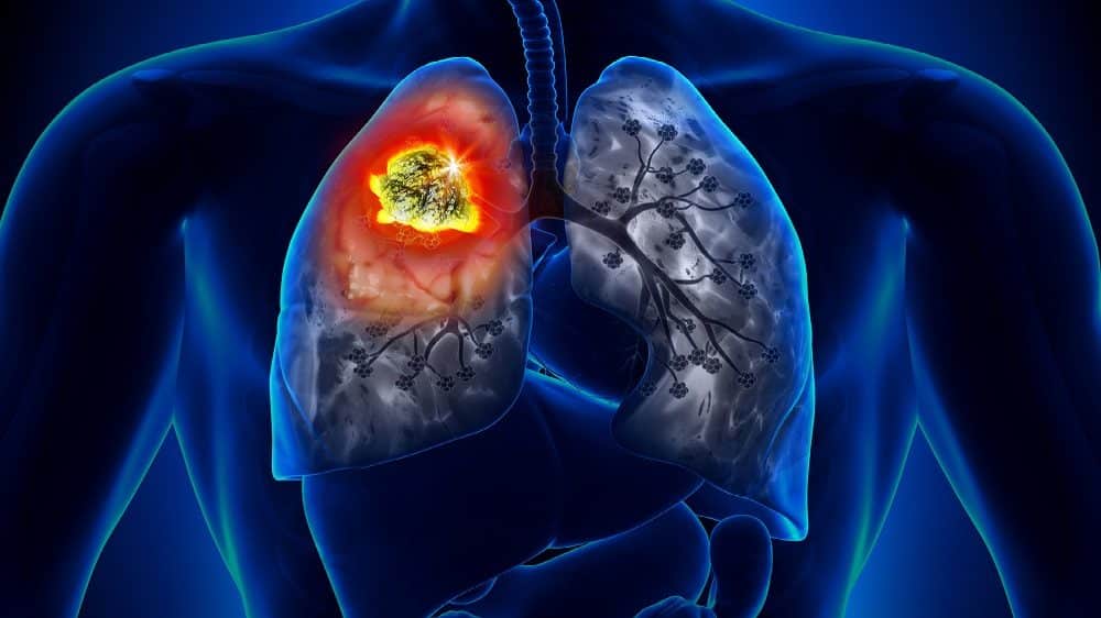 Cuidado com esses sintomas, você pode estar com câncer de pulmão sem saber