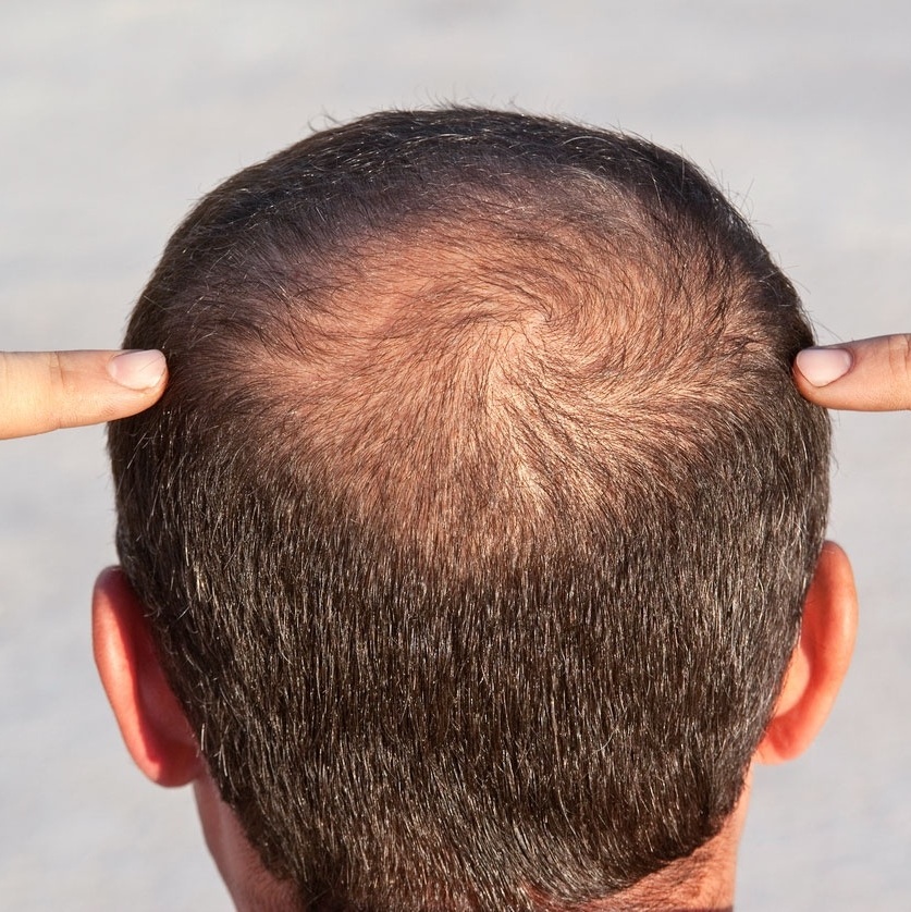 Queda de cabelo: médico aponta quando o caso é para tratamento