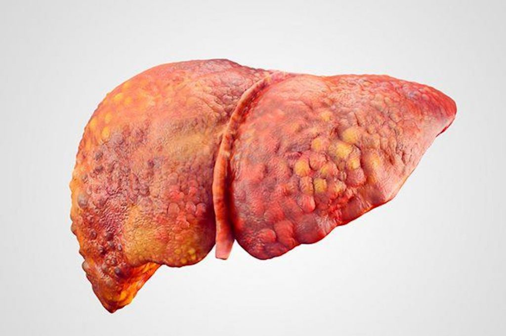 Veja os 8 principais sintomas de gordura no fígado e como tratar